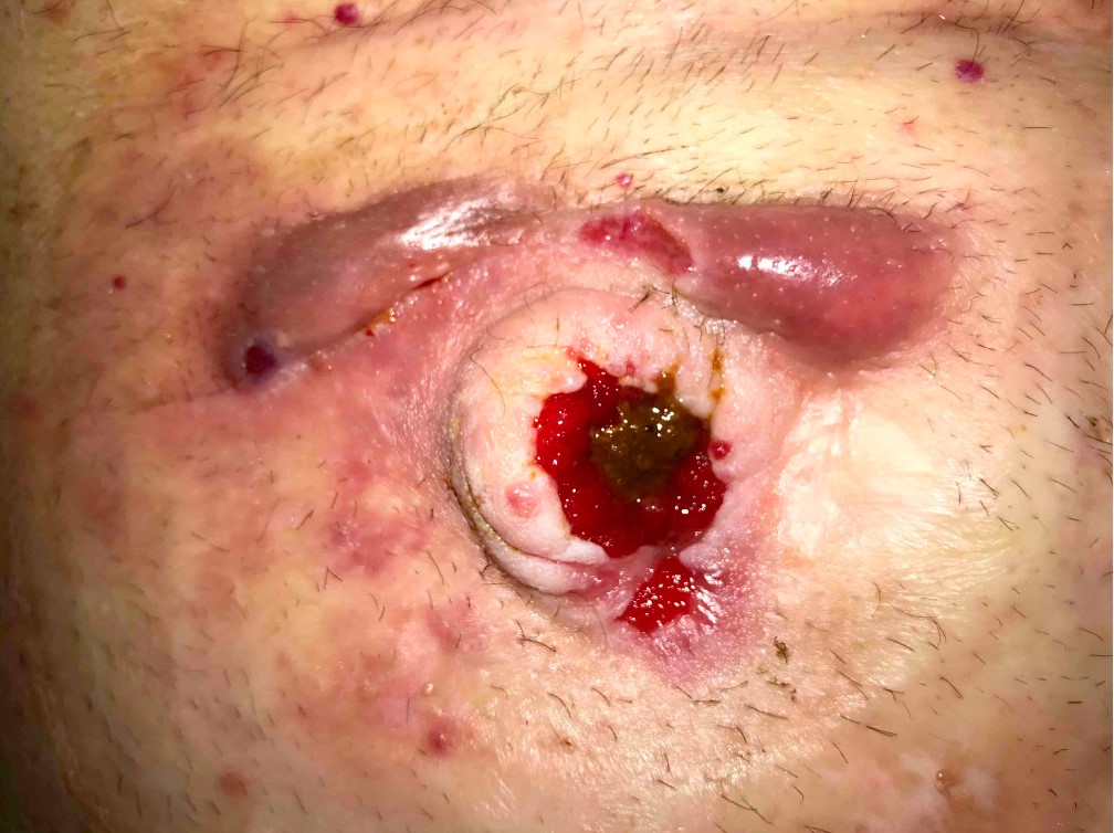 This issue highlights a review of hidradenitis suppurativa developing in a peristomal location.